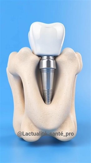 implant dentaire #corpshumain