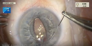 Iris-Sutured IOL Approach - Eyetube