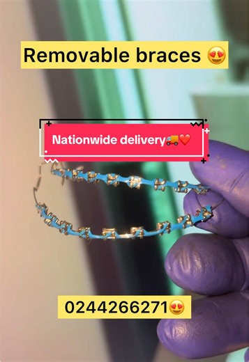 Exploring Removable Braces: Styles and Benefits