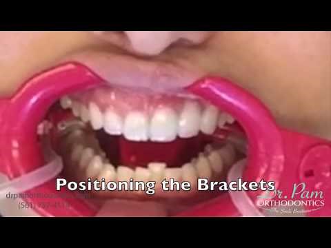 Placing Lingual Braces - aka Inside Braces