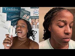 CHEMICAL PEEL | 7 Day Full Process | ￼Dr Visit | Before & After