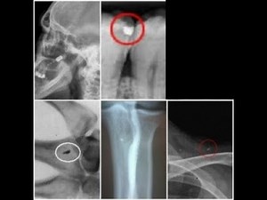 Abduction Implants - National Press Club - Dr. Leer Dr. Moser