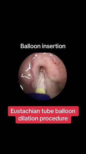 In-office #eustachiantube balloon dilation. Fast procedure, fast recovery, no #eartubes. No need to keep water out of the ears! #reddysinus #eustachiantubedysfunction #earpop #diving #airplane