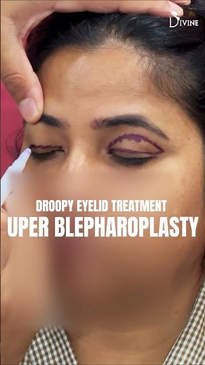 Upper Blepharoplasty for Droopy Eyelids | Eyelid Lift Results in 2–3 Weeks