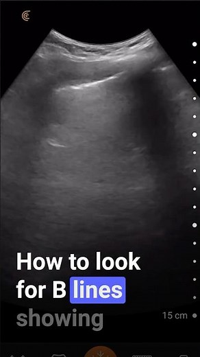 B Lines + Pulmonary Edema Ultrasound