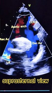 suprasternal view of the aorta🫀#echocardiography #viralvideo