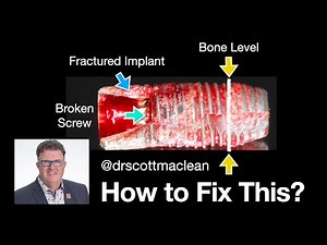 Socket Preservation After Implant Removal