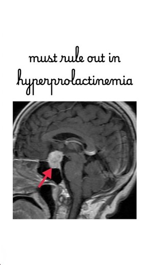 Hyperprolactinemia - USMLE HY
