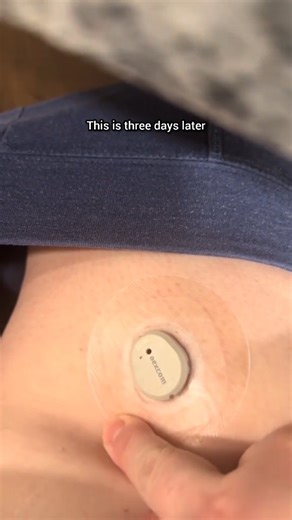 The best patches Lexcam for Dexcom G7 💙✨ #lexcamdexcomg7 #lexcamdexcomstelo #stelo #t1warrior #type1diabetic #t1dstrong #dexcom #dexcomwarrior #dexcomwarriors #type1warriors #dexcomcgm #dexcomg6 #diabeticstrong #diabetesmelitus #beyondtypeone #dexcomg7 #diabetessupport #curet1d #typeonediabetic #t1d #dm1 #type1d #dm2 | LexCam