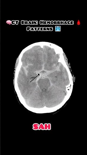 Can you spot the difference between SAH, EDH, and SDH? #doctor #reels #fyp #radiology #medicosstuff