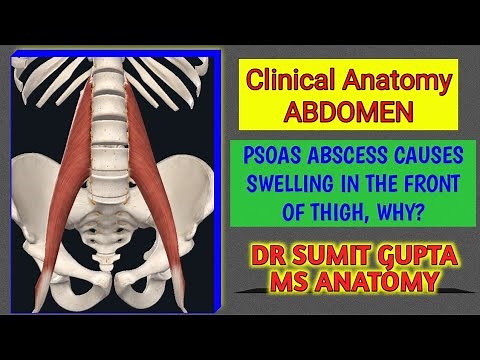 Psoas Fascia & Psoas Abscess