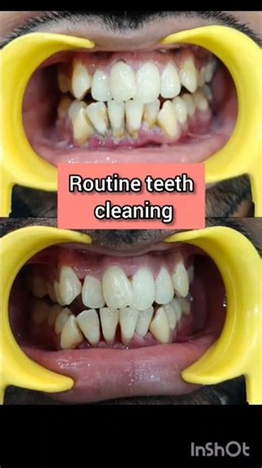 Crooked Teeth = Dirty Teeth? 😳 Truth About Plaque & Cleaning #shorts #dentist