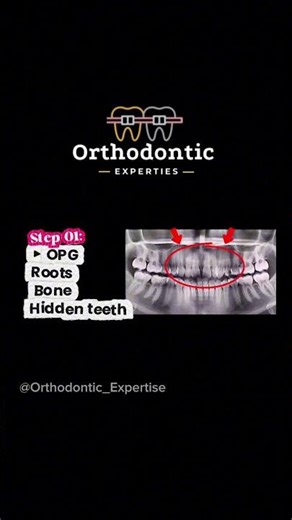 Tooth Gap Fix? 4 Steps First