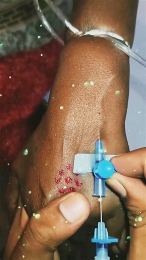 Intravenous Cannula technique..#shortfeed #shorts #ytshorts #trendingshorts #motivation