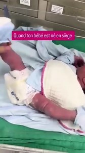 #Naissance : Présentation du siège décomplété. On parle ainsi de présentation du siège décomplété , quand à l'accouchement le bébé se présente avec les fesses vers le bas , les jambes tendues en haut et les pieds proches de la tête. Certains facteurs peuvent favoriser cette présentation du siège : - Causes foetales : Prématurité, grossesses multiples (deuxième jumeau), malformations foetales. -Causes utérines : Malformations utérines, multiparité, fibromes utérins. - Causes ovulaires : Placenta 