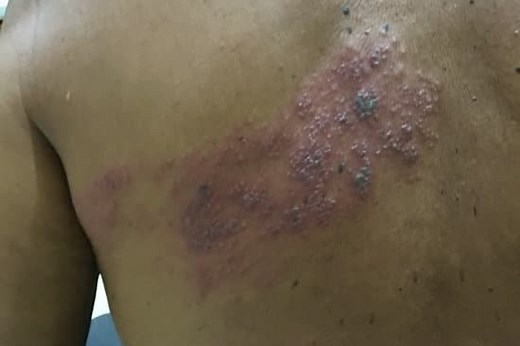 Il fuoco di Sant'Antonio è contagioso? E per i bambini ?|Si può uscire di casa ? AGGIORNATO 2026