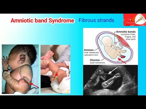 amniotic band syndrome