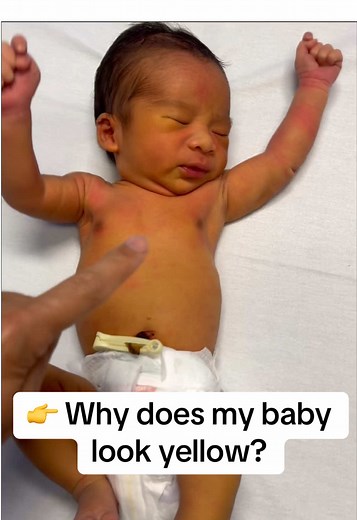 Understanding Newborn Jaundice and Bilirubin Levels