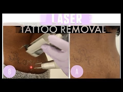 GOODBYE Tramp Stamp! LASER TATTOO REMOVAL on Dark Skin| LaserAway