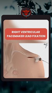 21K views · 139 reactions | Right Ventricular Pacemaker Lead Fixation...