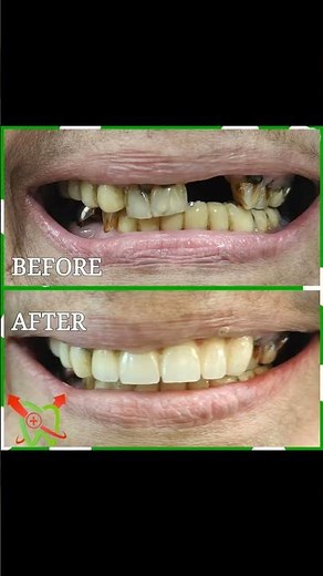 Permanent Non-Surgical Solution for Missing Teeth Discover a revolutionary treatment