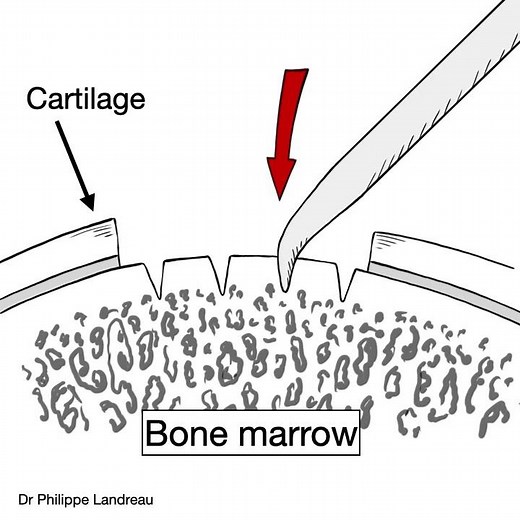 Microfracture for cartilage lesion