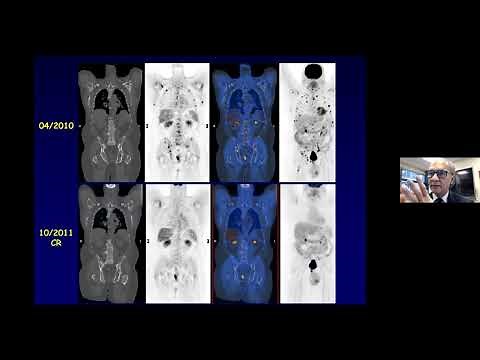 Multiple Myeloma 101: Diagnosis, Prognosis, and Risk: Nikhil C. Munshi, MD