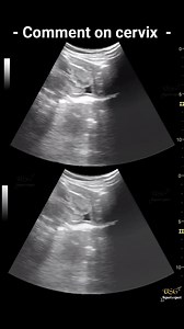 26 YRS OLD FEMALE PATIENT HISTORY OF SEVERE WATER DISCHARGE 💦 AND PELVIS PAIN SINCE 3 DAYS 😲 😲 😮 #Radiology #Ultrasound #MedicalImaging #FetalUltrasound #ObstetricUltrasound #PrenatalUltrasound #Sonography #DiagnosticImaging #FetalAnomalyScan #PrenatalScreening #ObstetricRadiology #FetalMedicine #MaternalFetalHealth #EarlyPregnancyScan #Radiologist #Sonographer #MedicalDiagnosis #OBGYN #PerinatalCare #HighRiskPregnancy #MaternalHealth #Medical #Healthcare #MedLife #FutureDoctor #MedTech #Med
