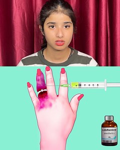 6.7K views · 35 reactions | ASMR Maggot Infested Finger Removal surgery | Severely Injured | Mahi | Facebook