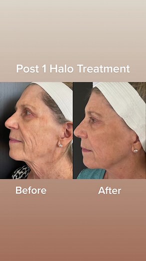Our patient had some fabulous results post her Halo/BBL treatment!