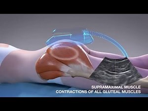 EMSCULPT® MOA for muscle toning and body contouring