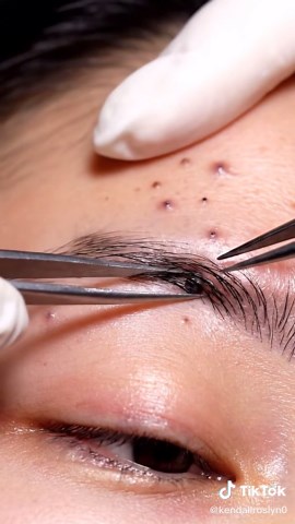 Deep Pore Cleaning ASMR: Most Satisfying Extraction