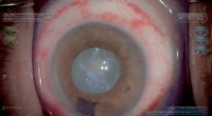 Femtosecond "Cheat Code" for a Swollen, White Lens - Eyetube