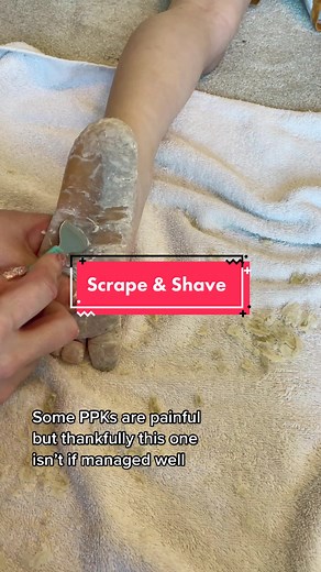 Callous Removal Process on One Foot