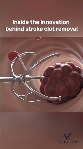 Inside the Innovation Behind Stroke Clot Removal | Endovascular Thrombectomy Explained #stroke