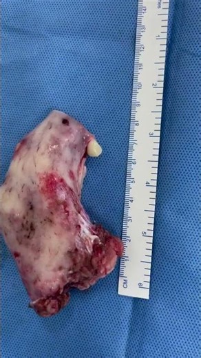 Aggressive Bone Tumor - Resection and Reconstruction