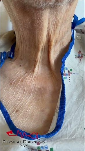 Corrigan's Pulse in a Patient with Severe Aortic Regurgitation