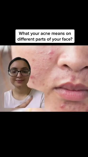 Understanding the Causes of Acne on Different Parts of Your Face