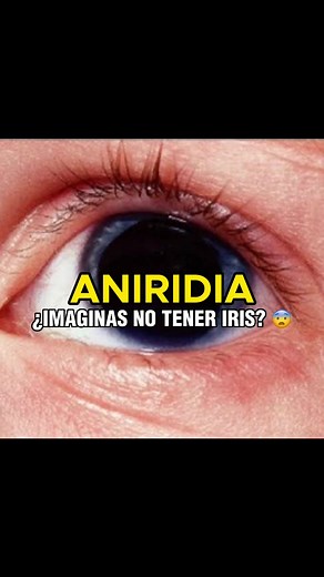 Aniridia: ¿Qué es y cómo afecta a los ojos?