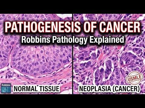 How Cancer Spreads: The Metastatic Cascade Explained