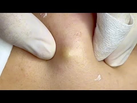 Removing Cystic & Blackheads: Deep Cleanse Skincare Journey