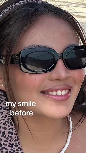 Smile Transformation: Gingivectomy Recovery and Aesthetics