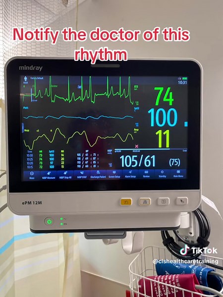 What is bigeminy? Bigeminy is a type of abnormal heart rhythm in which every other heartbeat is a premature contraction or extra heartbeat. 🤔🤔🤔🤔🤔🤔🤔🤔🤔🤔🤔Frequent or severe episodes of bigeminy in someone with a heart condition could increase the risk of serious heart problems. An electrocardiogram (EKG) can be used to diagnose bigeminy PVC. On an EKG, PVCs are considered frequent if there are more than five per minute, or more than 10–30 per hour during ambulatory monitoring. #ekg #ekgi