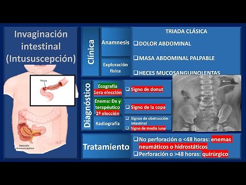 Intussusception: causes, diagnosis, and treatment. For the #enarm exam