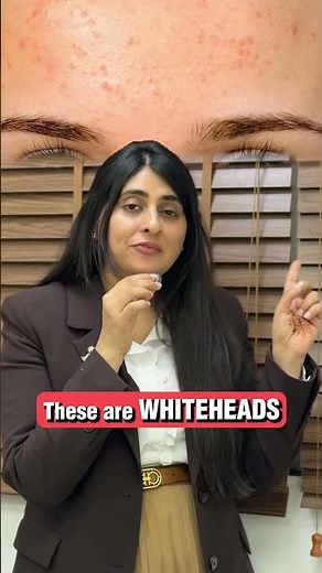 What are Milia, what are Whiteheads? How to treat Milia?