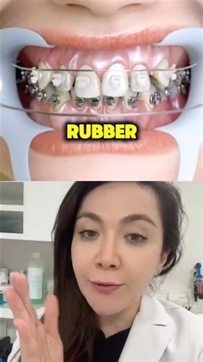 Why Does Braces Take Few Years To Work?!