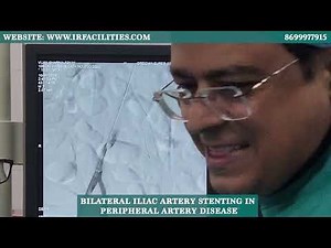 Bilateral Iliac Artery Stenting in Peripheral Artery Disease | Step-by-Step Procedure | IRFACILITIES