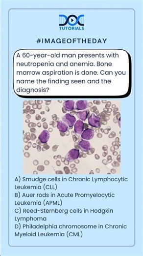 Can you name the finding seen and the diagnosis?