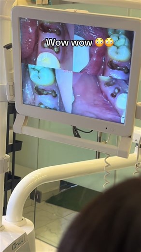 Retained Root means that a part of the tooth root is still left inside the gum or bone after the crown (top part) of the tooth has broken or been removed. #fyp #fupシ #teeth