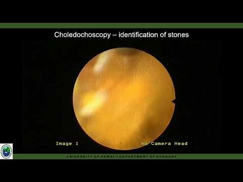 Percutaneous electrohydraulic lithotripsy in the effective management of choledocholithiasis for...